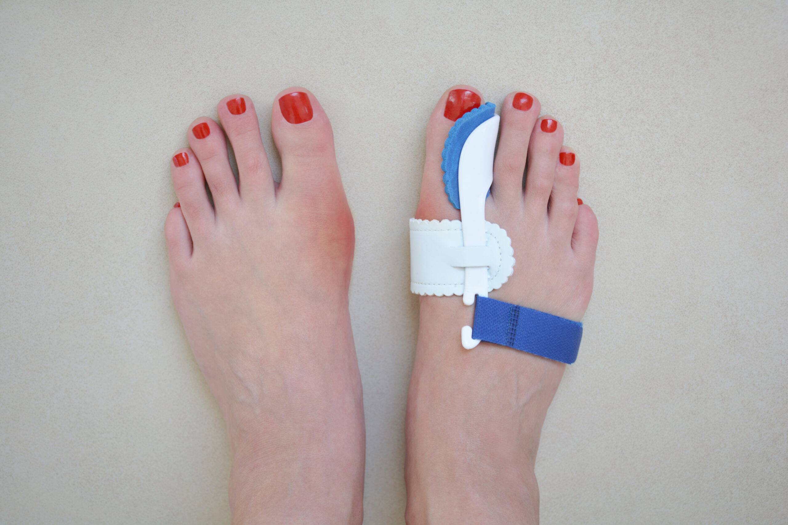 bunion pads