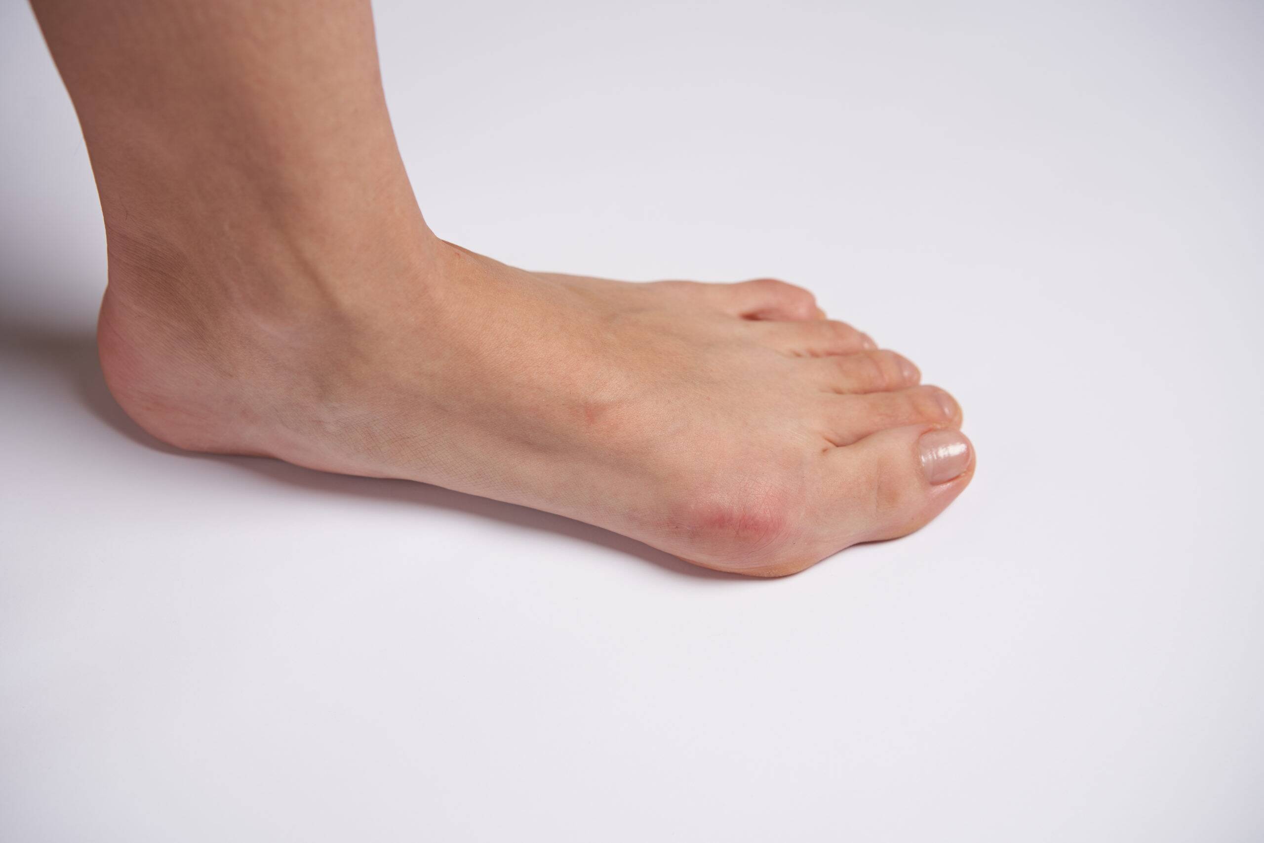 Bunion and hammertoe pain