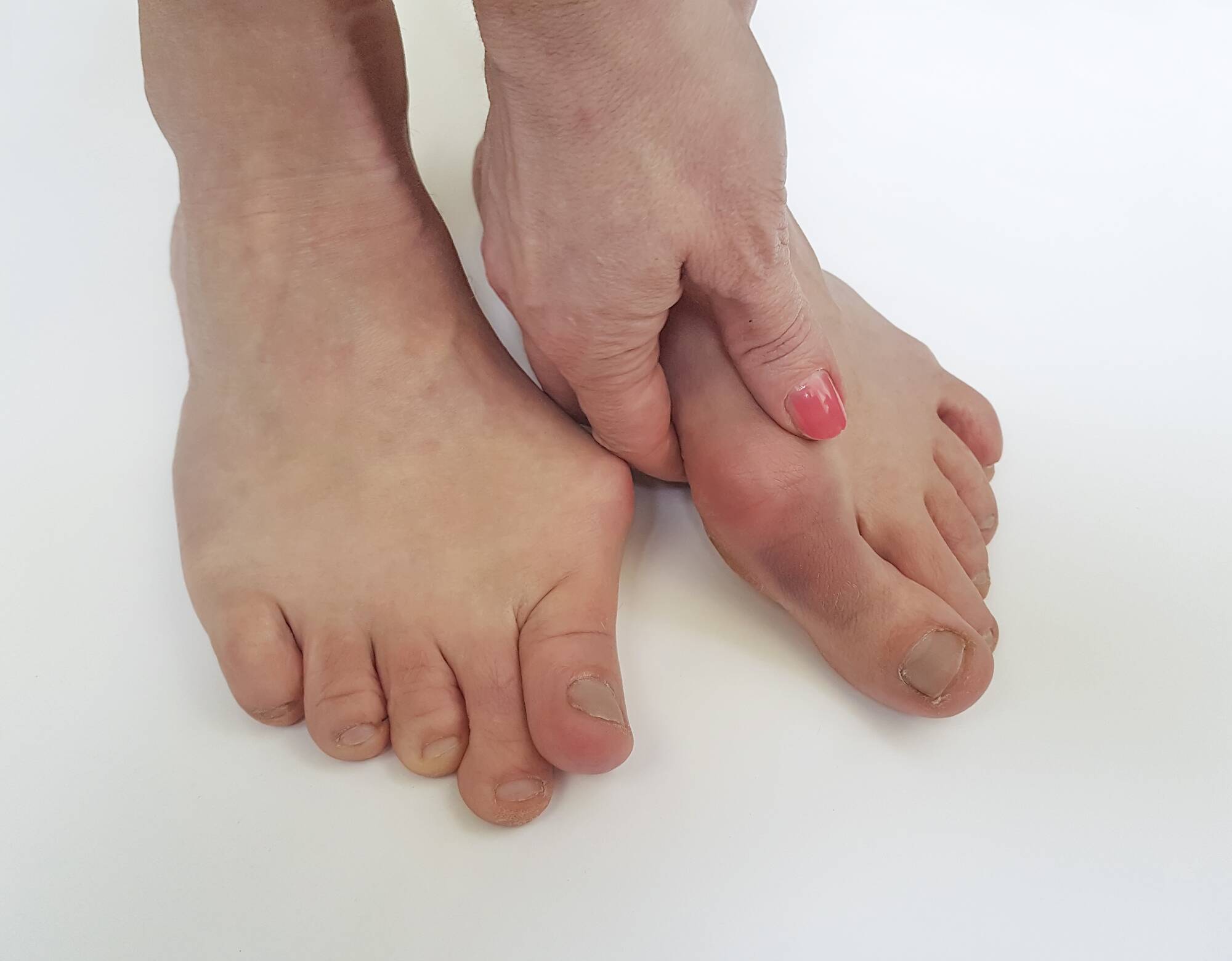 bunion pain treatment