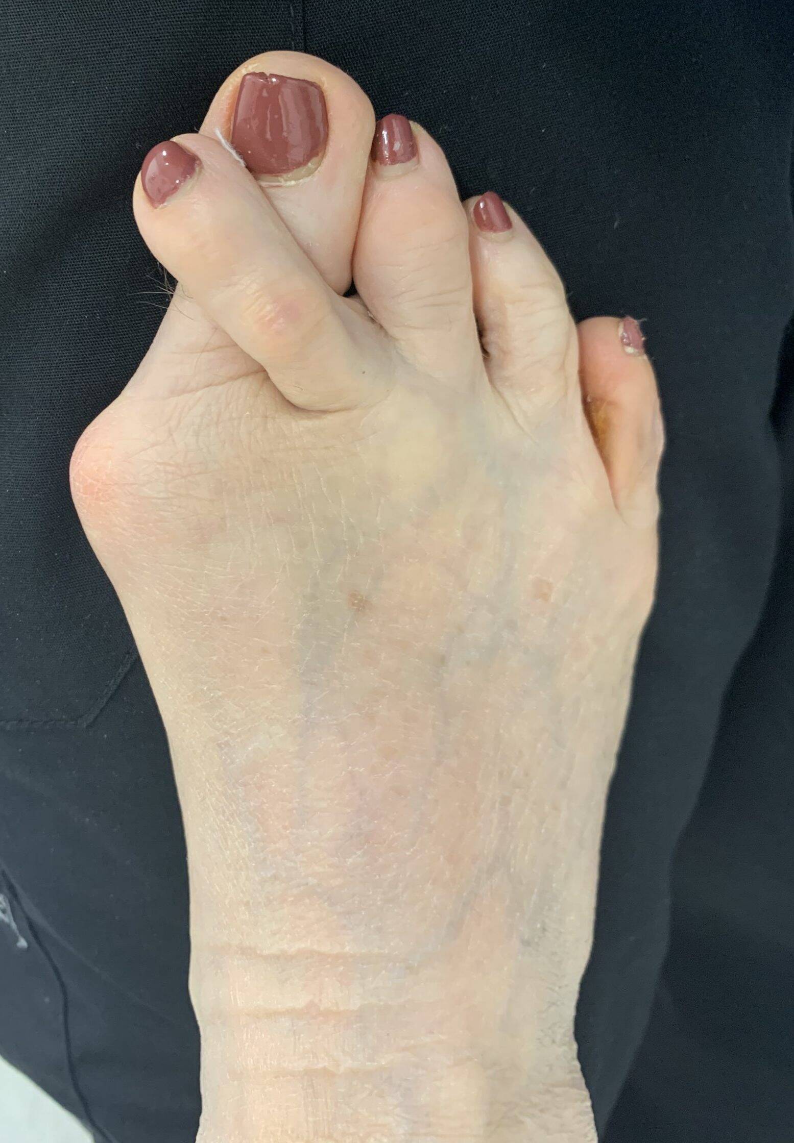 Before Surgery