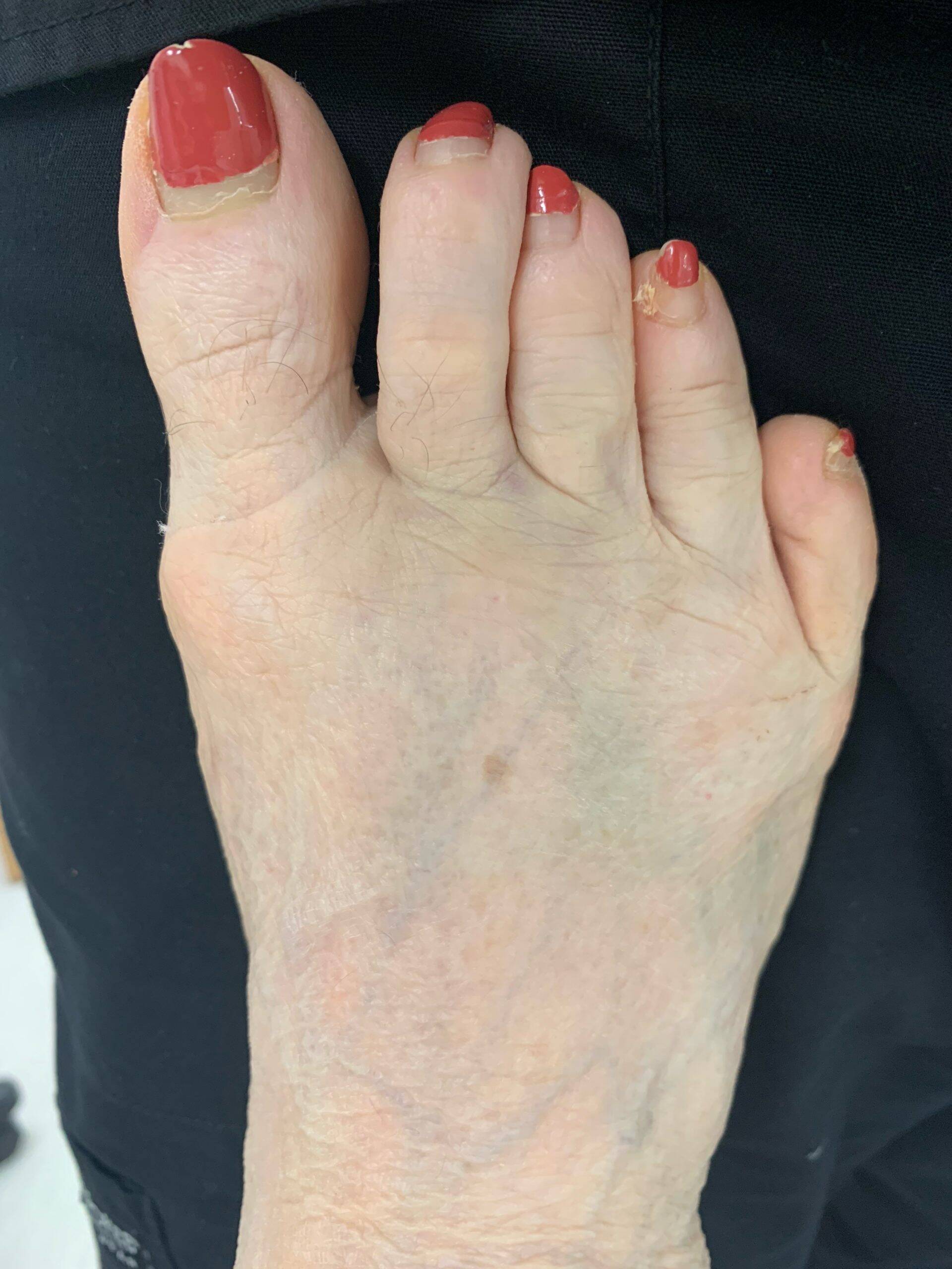 After Surgery