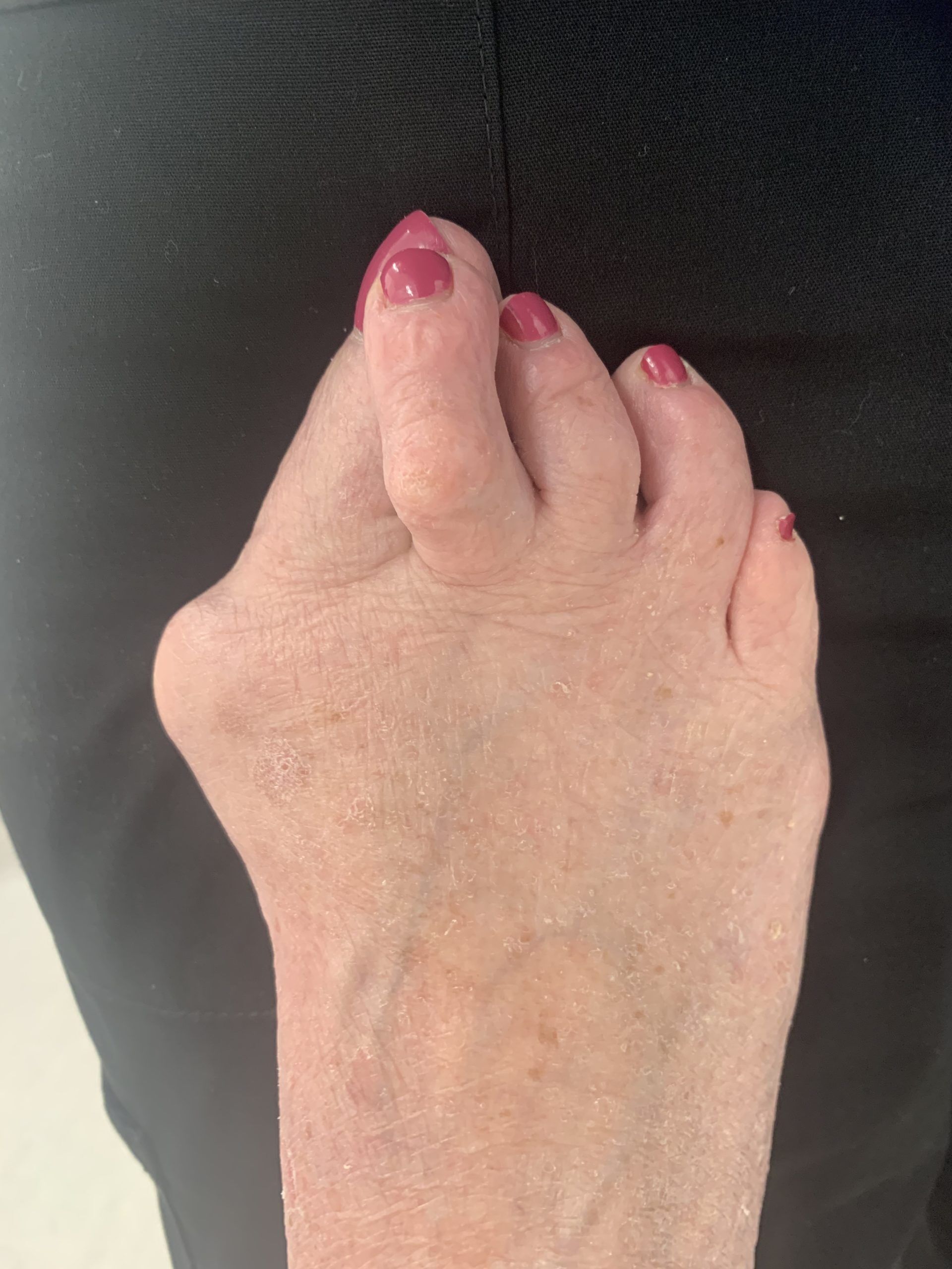 Severe Bunion Before and After Photos | Northwest Surgery Center