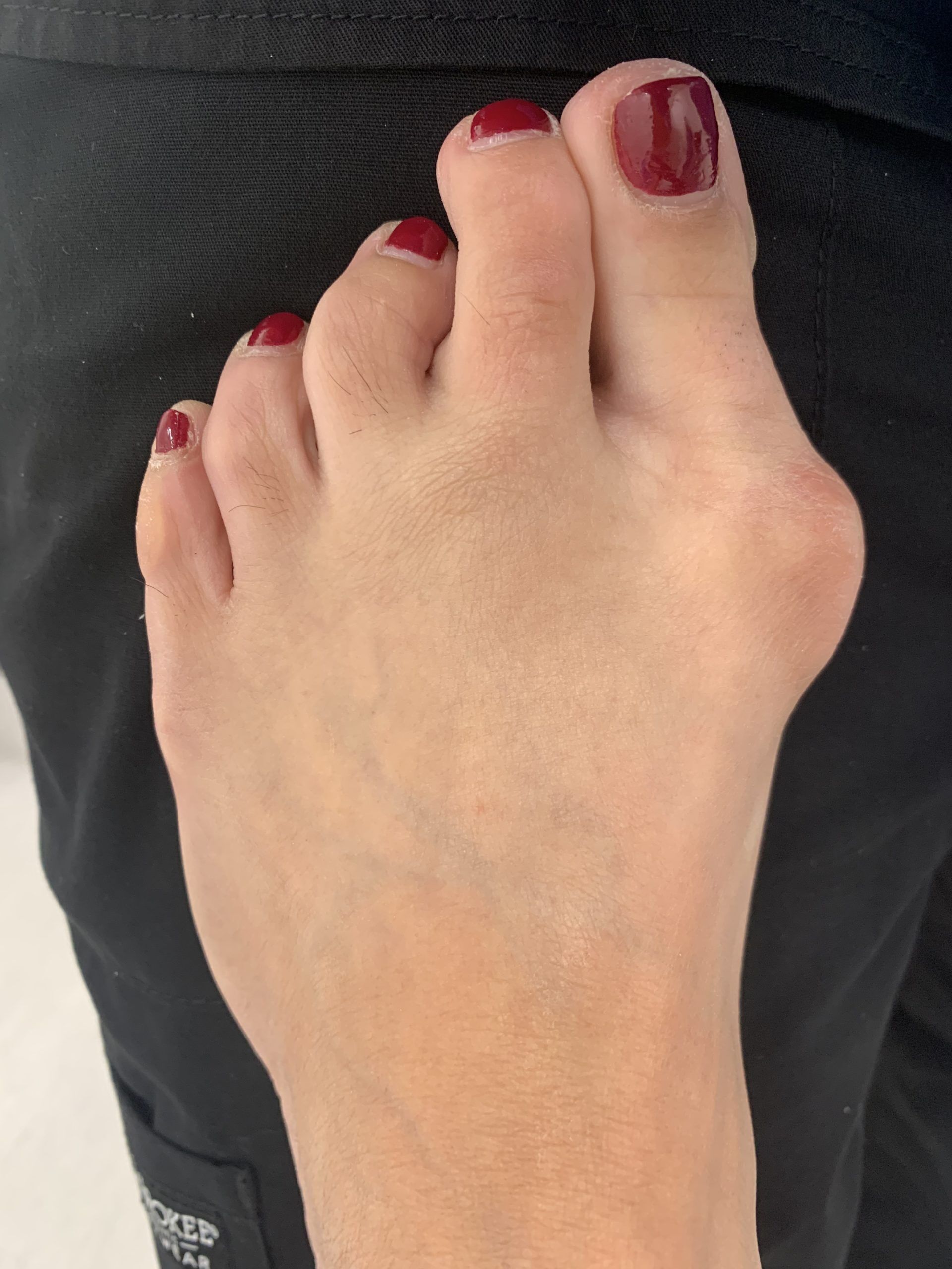 Severe Bunion Before and After Photos | Northwest Surgery Center