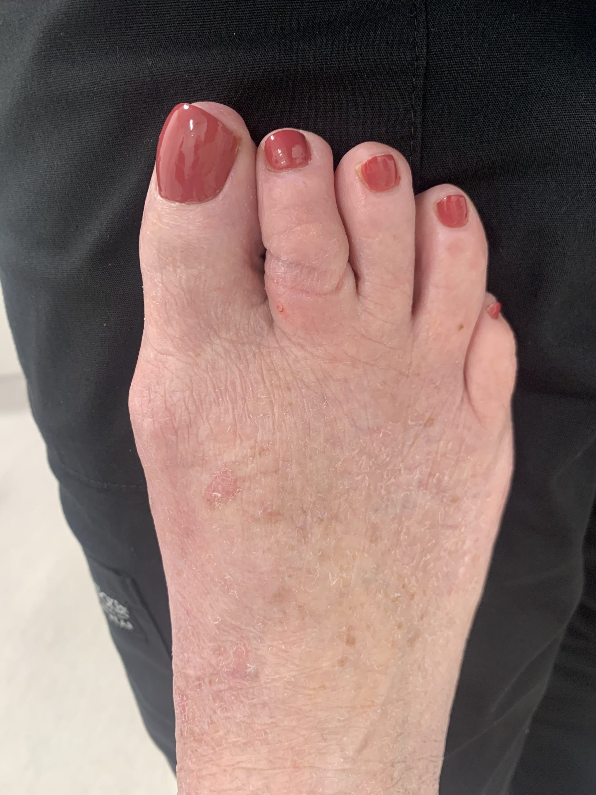 Severe Bunion Before and After Photos | Northwest Surgery Center