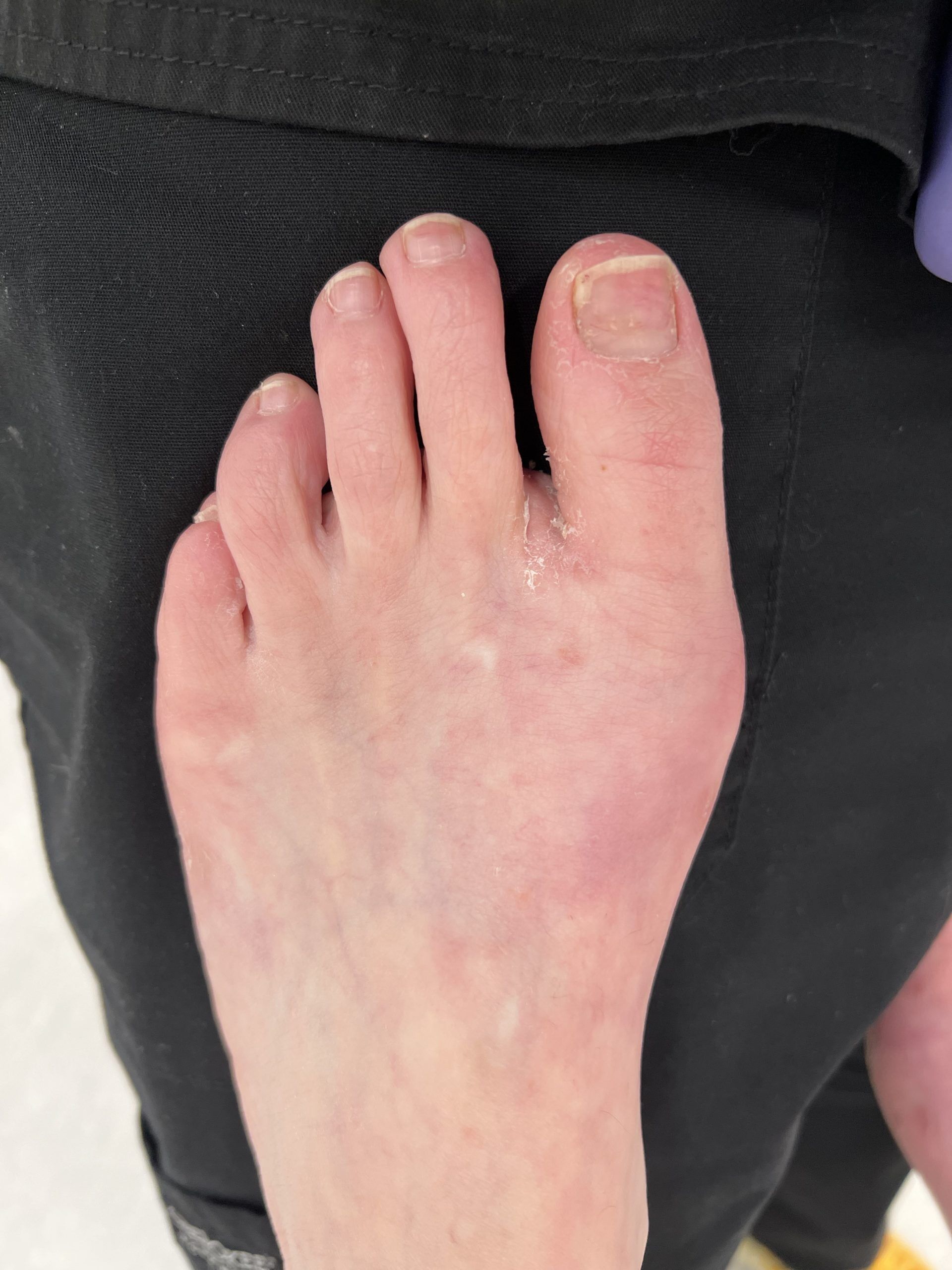 Severe Bunion Before and After Photos | Northwest Surgery Center