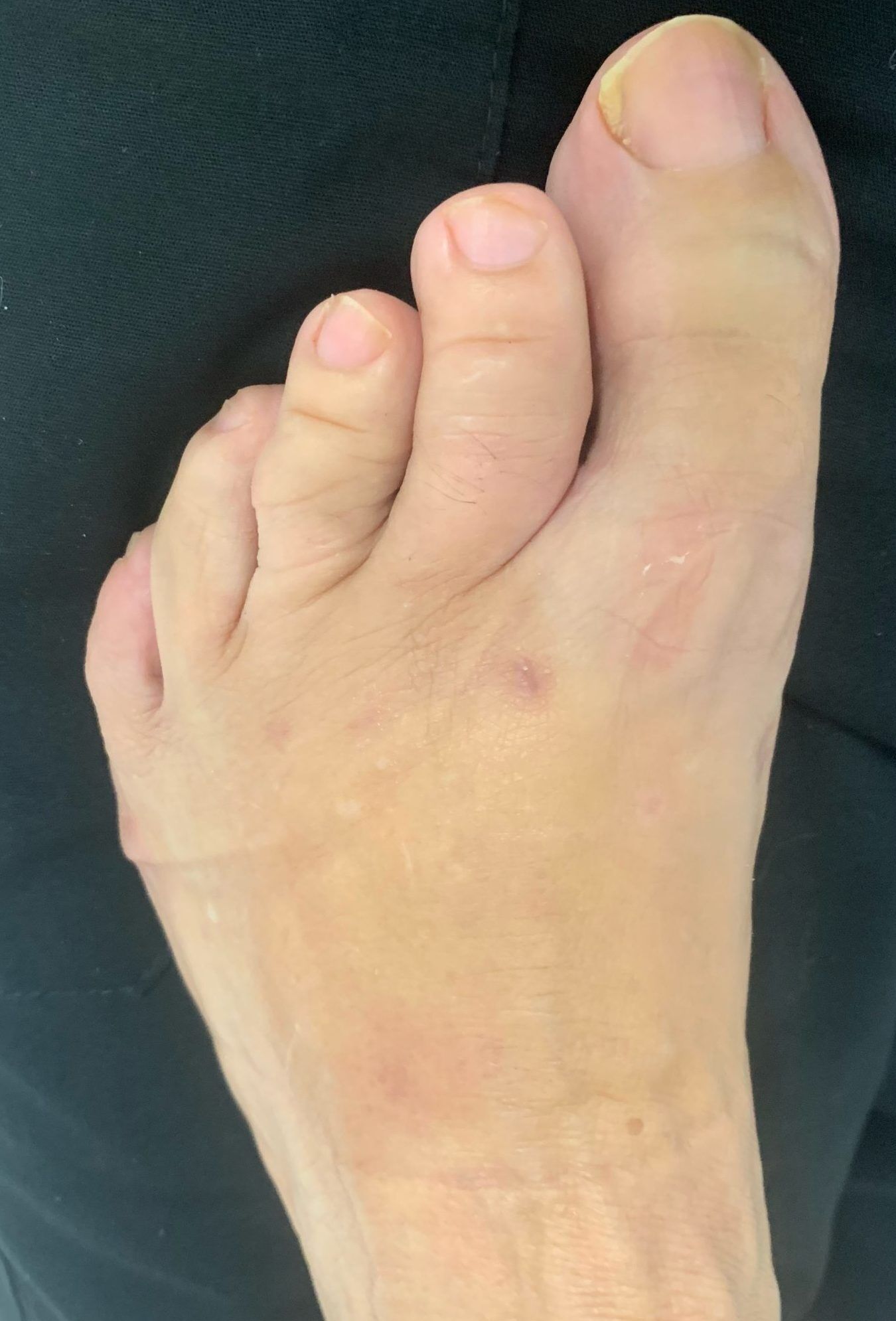 Severe Bunion Before and After Photos | Northwest Surgery Center