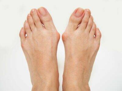 Bunion vs Callus: Key Concepts and Ways to Treat